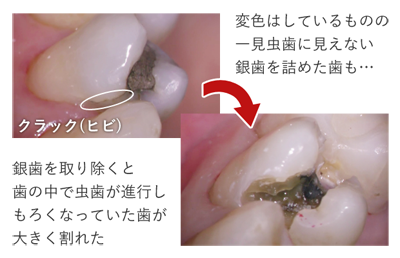 銀歯とマイクロクラック