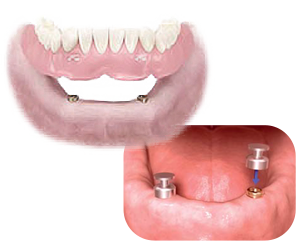 リハビリ用義歯