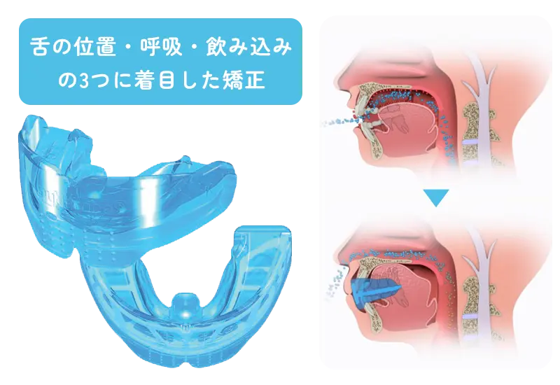 マイオブレース